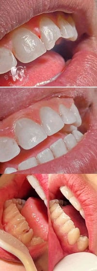 حشوات تجميلية • إعادة تفاصيل السن • مجمع اليمامه