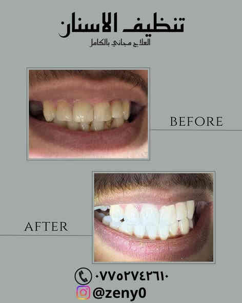 علاج مجاني بالكامل 🕊️
الخدمات المتوفرة :
🕊️فحص الاسنان
🕊️قلع الاسنان التالفه وجذور الاسنان المتبقيه
🕊️" تنظيف الاسنان وازالة التكلسات
🕊️حشوات ضوئية بيضاء تجميليه لعلاج تسوس وكسر الاسنان الاماميه
🕊️تعويض الاسنان المفقودة بطقم جزئي متحرك
🕊️(العلاج مجاني بالكامل)
📍• العنوان : بغداد جامعة الفراهيدي – حي القادسية، شارع قطر الندى، قرب جامعة ابن سينا للعلوم الطبية وبالقرب من جسر الجادرية
💕للتواصل : د. زينب محمد الرشيد
واتساب |***********
Zeny0/ انستا
