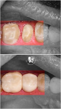 تغليف زاركون • إعادة تفاصيل الأسنان • مجمع اليمامة