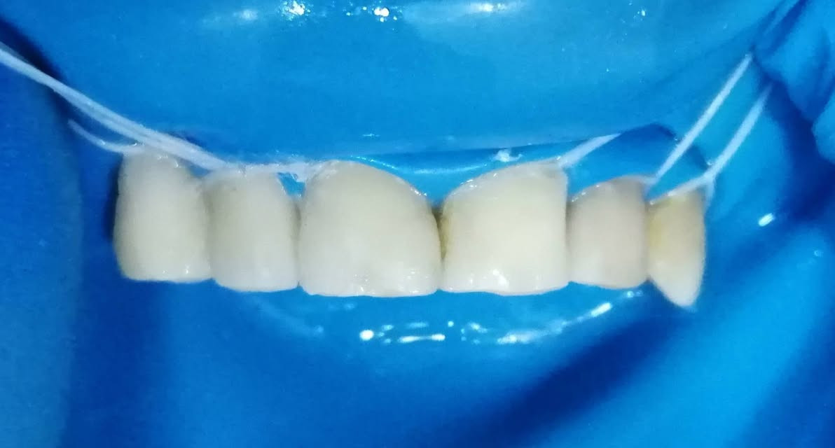 ترميم وتجميل الاسنان الاماميه بحشوات تجميليه باستخدام العازل المطاطي.
د مهند عبد الجواد الطحان الهاشمي
ماجستير ودبلوم عالي تعويض الأسنان
سايدين مستشفى#القيارهالعام
مقابل باب الطوارى الرئيسي
مجاور صيدليه عبدالله المعماري للحجز والاستفسار التواصل على الرقم ***********# طابق ارضى
