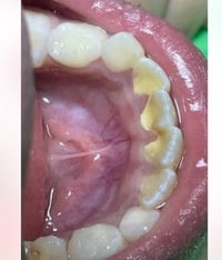 اللي تريد تنظيف اسنان من اي تكلسات نفس الصورة او اكثر ونلمع الاسنان ال...