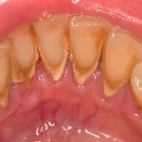 تكلسات • جذور متبقية • علاج مجاني