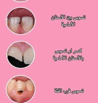 نعمل حشوة تجميلة لأسنان الامامية🤗 للاستفسار التواصل على هذا الرقم 0782...