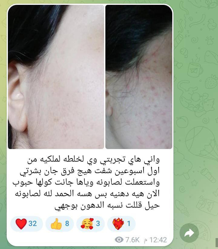 الخلطة الملكيه 😍 الااصليه
‏ღ  فعالة من اول  علبة خلال  ايام نتائج مبهرة
#بخلاصة_الصبار والكولاجين والفيتامينات من منتجات شركه فوريفر خاليه من المواد الكيميائيه  😍😻
1 تبيض وتوريد البشرة🙆
. 2 وأزالة الكلف.النمش.التجاعيد💆
. 3 واثار الحب وتساعد في التئام الحفر🤗
. 4 وتورد الوجة .تبدأ النتائج خلال 7 أيام فقط 🌹
. 5 ازالة التصبغات .✔
6 وازالة السواد حول العين ★👰
.7 تضيق المسامات😙
8 ازالة حب الشباب✔

طريقة الاستعمال تضع كمية مناسبة
 على الوجه وغسلها في الصباح
 
👑معجزة التبييض مع خلطة لينا بيوتي
الحل الامثل للنساء 👩والرجال👨
🔴لتبييض الوجه.
🔴علاج الكلف بالوجه وحب الشباب واثاره.
🔴ازالة التصبغات ،والهالات السوداء.
🔴عدم صفاء ونقاوة البشره.

 👌عدنه الحل💥:⏬⏬⏬
👑:  خلطه سحريه ✨ لتبييض الوجه خلال 3 أيام فقط🤔وبمفعول دائمي 🕛
 👑تغذي وترطب طبقات الجلد. وتزيل الكلف والنمش والتصبغات ☛وتوحد لون البشره 
 واايضا التخلص من حب الشباب واثاره .تبيبض البشره من 5الى 7 درجه
تتكون من مواد عشبيه🌿تناسب جميع انواع البشره 
نتائج دائميه ومضمونه💯

🦋🫀🦋🫀🦋🫀


**إذا كنت صاحب هذا الإعلان وتريد حذفه لأي سبب، رجاءا أرسل رسالة إلى الدعم الفني**