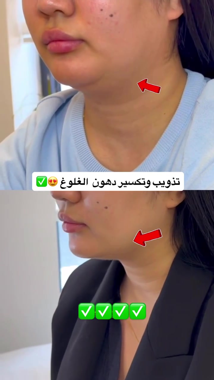 عروضنا المجانية مستمرة إلى أهالي الحسينية ويانا غيررر😍❤️
زورونا بموقعنا 📍
العنوان: الحسينية – شارع المكاتب – مقابل السوق الكبير – مجاور محلات اللامي ومعرض بغداد
اسم المجمع: مجمع شفايا الطبي الخيري

*********** للحجز أو الأستفسار👄💉
تنورونا وكل الهلا 😍🩷🫶
