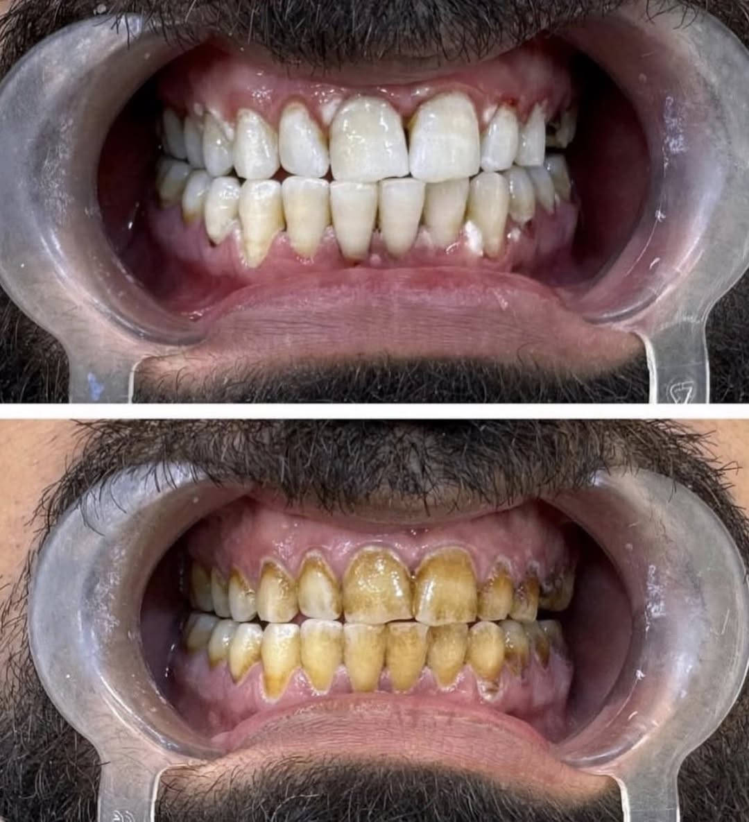 �✨ عروض عيد الأضحى في عيادة الرسالة ✨🎉
خصومات قوية تصل إلى 50% 😍🦷
على:

🔹 تنظيف الأسنان
🔹 إزالة التكلسات والتصبغات
🔹 تبييض الأسنان بالليزر ✨

اغتنم فرصة العيد وخلي ابتسامتك أنظف وأجمل بثقة 🤍

📍 حي الرسالة – مقابل شارع عشرين حي الإطارات من جهة الرسالة
📞 للحجز والاستفسار: ***********
