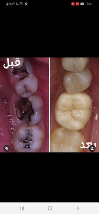 من رخصه الادمن.. منو محتاج يسوي تنظيف لاسنانه او عنده تكلسات نكدر نظفه...