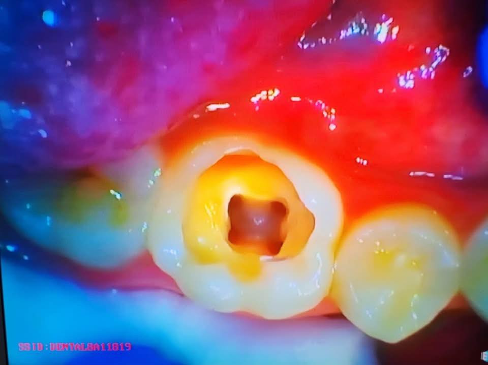 حشوة جذر للسن الخلفي
طبيب الاسنان الاختصاص د.عمار عباس
ماجستير تقويم وتجميل الاسنان M.S.c ortho
بكلوريوس طب وجراحة الفم والأسنان B.D.S
بغداد الشعب شارع عدن قرب  مركز شرطة الشعب  مدخل سوق شلال عمارة باريس الطابق الاول دوام العيادة جميع ايام الاسبوع ما عدا الجمعة عطلة من ٤ ل ٨  بدون حجز مسبق الدخول حسب اسبقية الحضور للعيادة الفحص والمعاينة مجاني للاستفسار ***********
