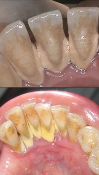 العنده هيج تكلسات ويريد تنظيف اسنان خل يتواصل وياي 🔹07742555956  الدكت...