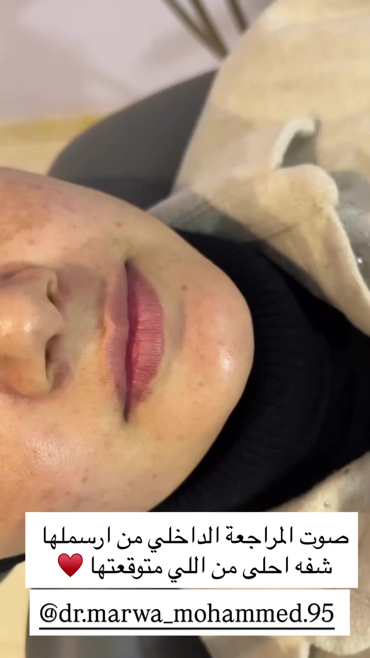 رسم شفة بالفلر الكوري ابتك مع حقن التفتيح للبشرة♥️ 
مرسومة✅
مقلوبة✅
مزمومة✅
ومكبوسة✅
عيادة الدكتورة مروة محمد التميمي
الديوانية العروبة-شارع المتحف-مجاور مطعم كودو كودو
رقم الحجز ***********
