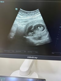 تلقيح اصطناعي • حمل توأم • الدكتورة راجحة الشمري