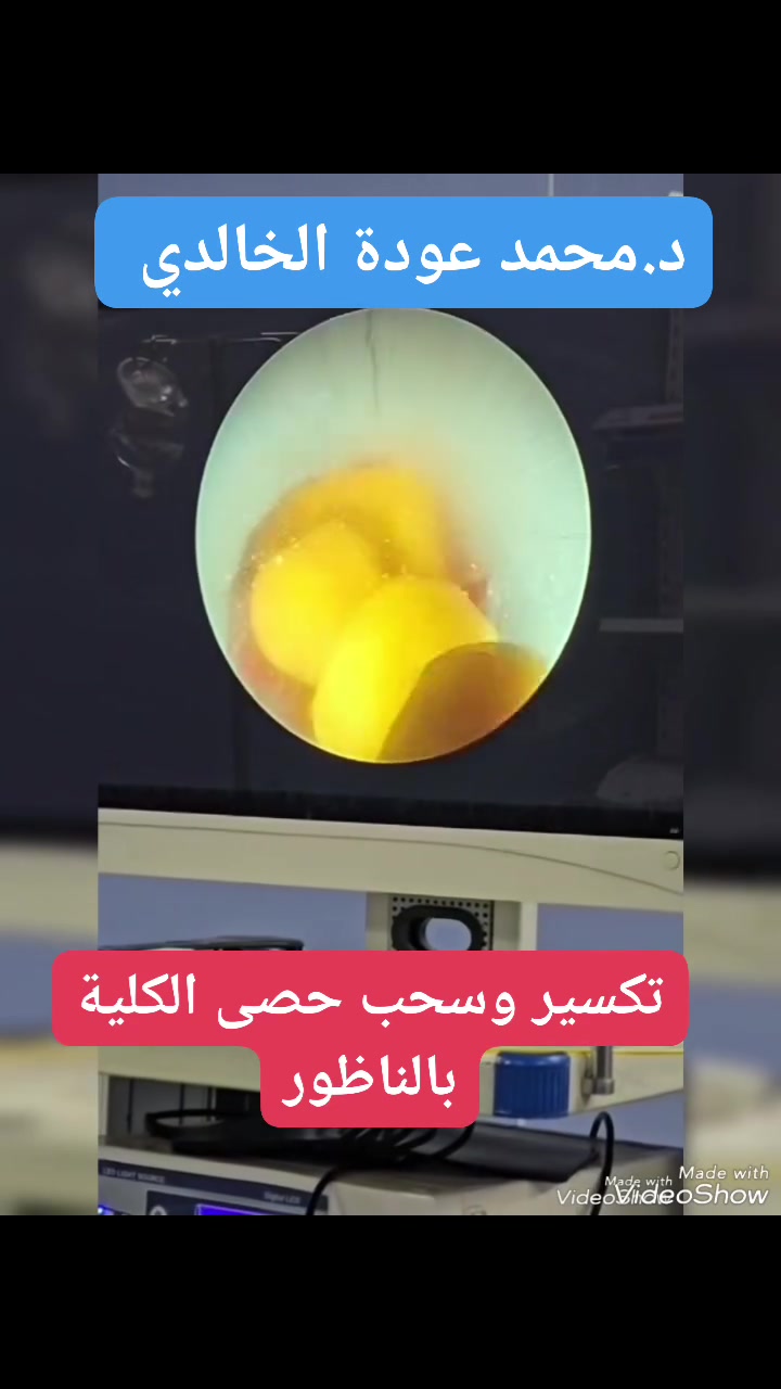 الحمد لله رب العالمين.
تكسير وسحب حصى الكلية بالناظور عن طريق الجلد.
صحة وعافيه #للجميع ان شاء الله.
🛑 الدكتور محمد عودة الخالدي 🛑
🔹الزمالة التخصصية (فوق التخصص ) في ناظور البطن البولي ( Laproscopic urology ).
🔹شهادة البورد العربي ( الدكتوراه ) لجراحة الكلى والمسالك البوليه والتناسلية والعقم.
🔹شهادة البورد العراقي( الدكتوراه ) لجراحة الكلى المسالك البولية والتناسلية والعقم.

🛑🛑الرجاء عمل اعجاب و متابعه ومشاركه  للصفحه لطفا🛑🛑
#everyone #الجميع
🏩🏥 العنوان : الناصريه الحبوبي. شارع التربية قرب صيدلية اسبرين. مقابل شارع هاشم الفنان سابقا.مقابل عيادة د هدى عدنان.

 ⁦🛎️⁩⁦☎️⁩ للحجز والاستفسار  :***********

نستقبل ونباشر علاج الحالات الخاصة بالمسالك البولية وتشمل :
🛑# معالجة حصى المسالك البولية ( #حصى الكلى، حصى الحالب، حصى #المثانة وحصى #الاحليل ) بالناظور PCNL، جراحيا وبالتفتيت الخارجي ESWL وحسب الحالة لكل مريض .

🛑 #اورام وجراحة الكلى وتشمل كل من عمليات الرفع الكلي والجزئي للكلى (فتح او بالناظور Laparoscope ).
🛑#رفع كيس الكلية بالناظور ( Laproscopic surgery).
🛑 #تشخيص علاج اورام المثانة بالناظور TURT وجراحيا.
🛑# تشخيص وعلاج تضخم #البروستات وإجراء عمليات رفع البروستات بالناظور TURP  وجراحيا. 
🛑 #تشخيص و علاج السلس البولي و#التبول الليلي
🛑 #عمليات #الناظور التشخيصي والعلاجي لانسداد وتضيق الاحليل.
🛑# تشخيص وعمليات تشوهات المسالك البولية الولادي وعمليات #تجميل #حوض الكلى و الحالب . 
🛑 تشخيص وعلاج #العقم الأولي والثانوي وتأخر الانجاب لدى الرجال وإجراء عمليات #الدوالي للخصيتين . 
🛑 #عمليات انزال وتثبيت #الخصية الهاجرة للاطفال جراحيا وبالناظور #Laparoscopy وعمليات #الفتق المغبني و#القيلة المائية للاطفال والكبار.
🛑 #عمليات الختان وإعادة الختان جراحيا مع إجراء عمليات تجميل المبال السفلي للاطفال.
