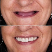 🔴مجاناً مجاناً 🔴 تعويض جميع الأسنان المفقوده بطقم جزئي وكامل  للتواصل ...