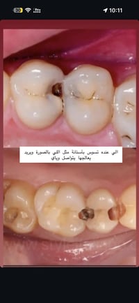 علاج مجاني • حشوات ضوئية • الحلة شارع اربعين