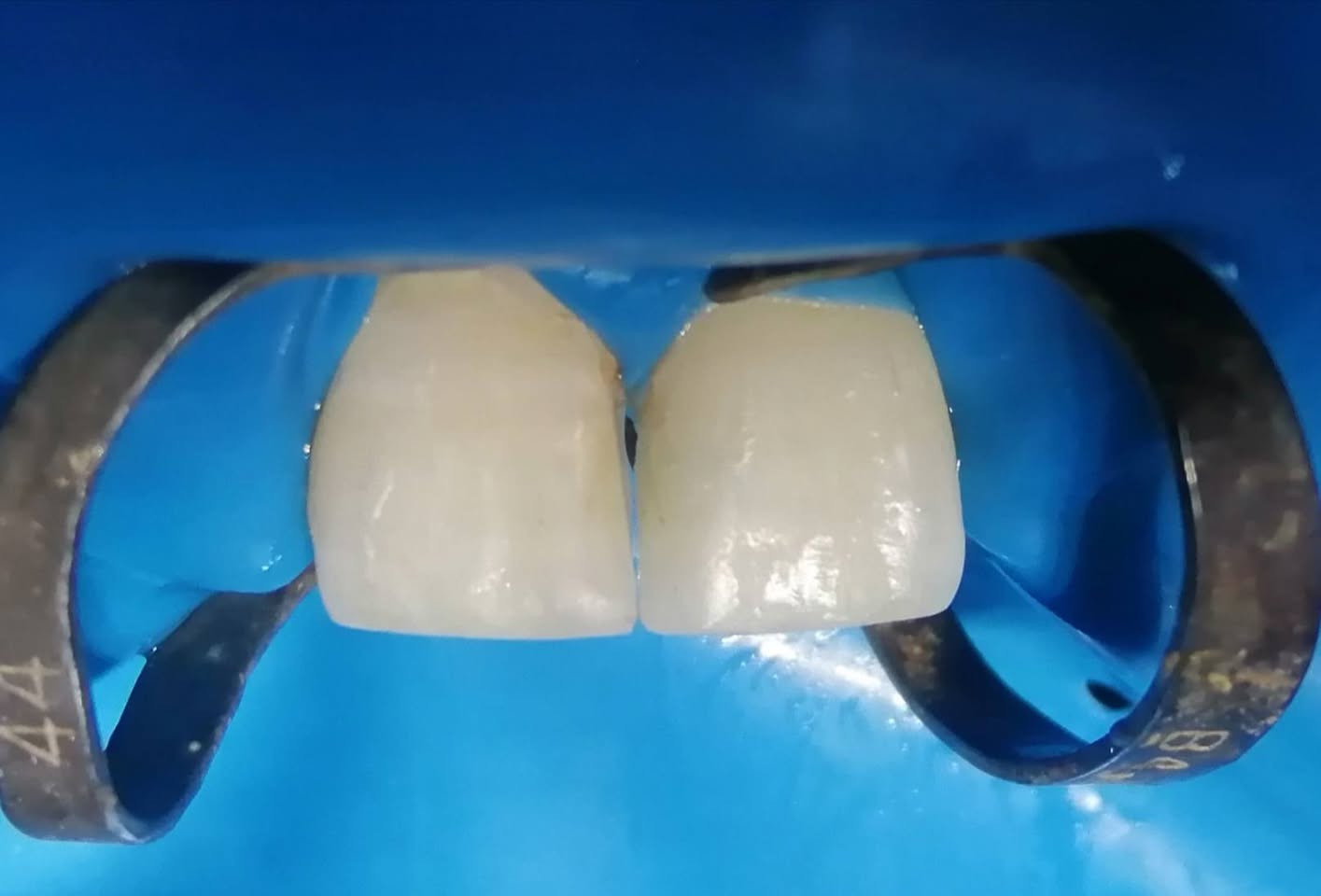 حشوات تجميليه للأسنان الاماميه العلويه باستخدام العازل المطاطي.
د مهند عبد الجواد الطحان الهاشمي
ماجستير ودبلوم عالي تعويض الأسنان
سايدين مستشفى#القيارهالعام
مقابل باب الطوارى الرئيسي في مستشفى القياره
مجاور صيدليه عبدالله المعماري للحجز والاستفسار التواصل على الرقم ***********# طابق ارضى
