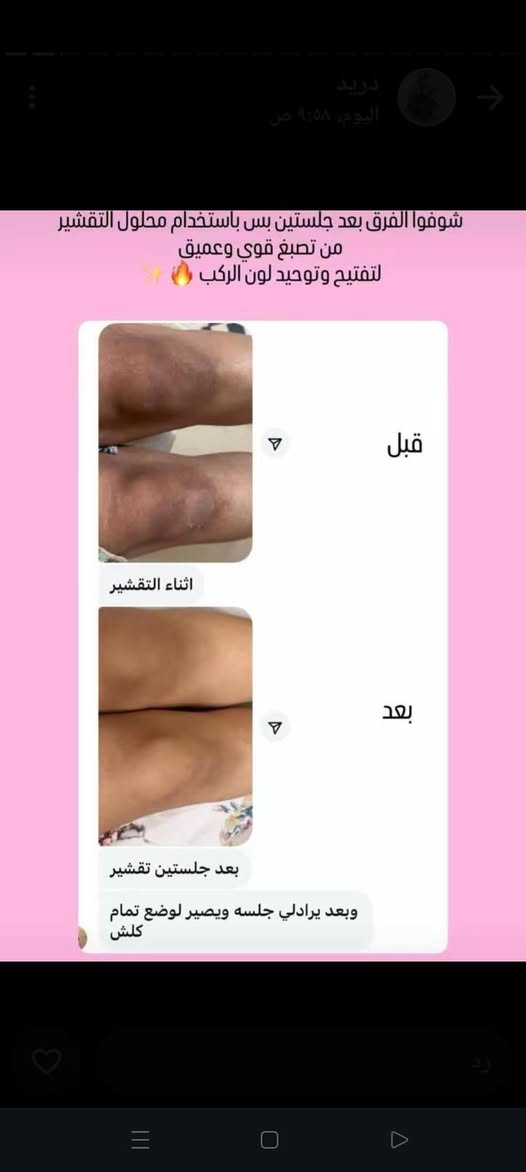 بنات متوفره لدينا مادة تقشير كاربوني 
توفرررت لدينا للحجز والاستسفسار مراسلتي خاص ***********
