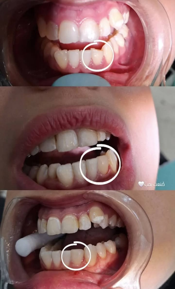 السلام عليكم
عيادة رينيو لطب وتجميل الاسنان
 بإشراف دكتورة كربلاء الاسدي بكلوريوس طب جامعه بغداد سرتفكيت فى التجميل اللاجراحي
للحجز: ***********
العنوان: بغداد مدينه الصدر قطاع 14 مقابل صورة السيـد .
