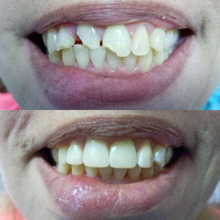 علاج مجاني لعدد محدود جدا 
حشوات تجميلية للاسنان 
عنوان / كربلاء ـ الحر 
للحجز والاستفسار راسلونا على الخاص 
او واتساب / ***********
