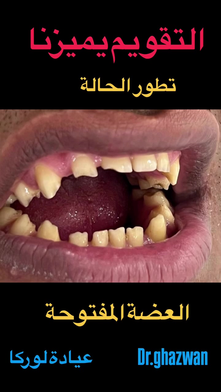 التقويم يميزنا احد الحالات المستعصية و المعقدة جدا العضة المفتوحة و عدم اكتمال غلق الفم عند الاطباق يعاني من مظهر خارجي غير متناسق و عدم القدرة على تقطيع الطعام و عدم لفظ الحروف و صعوبة اثناء الكلام و مشاكل اثناء التنظيف مستمرون حتى نهاية المرحلة العلاجية…. علاج جميع الحالات الصعبة و المستعصية نتائج ممتازة خبرة علمية جمالية الاسنان و الوجه و ترتيب و تنسيق و اصطفاف الاسنان في مواقعها النموذجية نضمّن النتايج اسعار مناسبة بالتقسيط المريح… دكتور غزوان مزهر بغداد الكرخ نفق الشرطة بداية شارع الاطباء عيادة لوركا فوق صيدلية كنز النفق متوفر واتس *********** #تقويم_الأسنان_والفكين #تقويمالأسنان #تقويم_الأسنان_بأنواعه #تقويم_الشفاف_للأسنان #تقويم_الأسنان_قبل_وبعد  @تقويم_الاسنان @تقدم_الفك_السفلي @العضة_المفتوحة @العضة_المعكوسة
