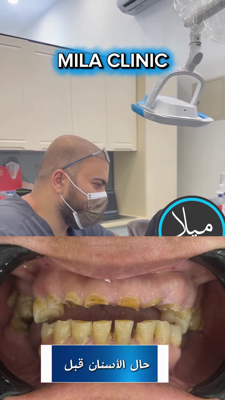 إذا كانت أسنانك متكسرة أو متعبة 😔
الحل يم ✨ عيادة ميلا لطب وتجميل الأسنان ✨

نوفر أحدث علاجات وتجميل الأسنان:
🦷 ترميم الأسنان المكسورة
🦷 ابتسامة هوليود ودايركت فينير
🦷 زراعة وتقويم الأسنان
🦷 علاج التسوس والعصب بأحدث الأجهزة

ابتسامتك ترجع أجمل وبشكل طبيعي 💎
📍 الزعفرانية بداية شارع المستشفى
📞 للحجز والاستفسار:*********** 

#عيادة_ميلا #تجميل_الاسنان #ابتسامة_هوليود #دايركت_فينير #زراعة_الاسنان #تقويم_الاسنان #بغداد #الزعفرانية

