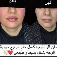 تغير شامل • ١٠ سي سي • ابرة هدية