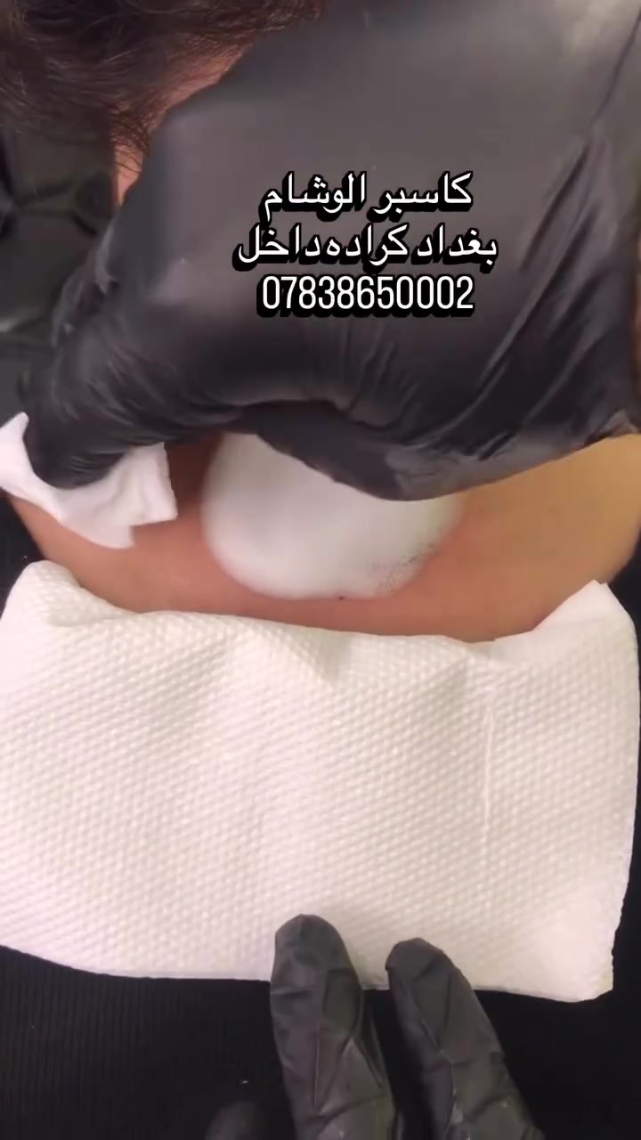 كاسبر الوشام 🎨🖼️👨🏾‍🎨 فنان تاتو طبي👨🏾‍🎨 تعقيم • أمان • نتائج دقيقة 📩 للحجز والاستشارة خاص تاتو حاجب 🤨 تاتو تجميلي🌹+طبي 👨🏾‍⚕️ ترميم وتجديد التاتو القديم 📜 ازاله تاتو والدك⚡️ محترف SMP بغداد كراده داخل        ***********  #وشم #تاتو #كراده_داخل #تاتو #بغداد
