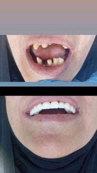 تركيب اسنان زركون • بعقوبه ديالى • مجمع الشفاء