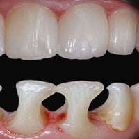 تغليف أسنان زيركون • مجمع اليمامة • خبرة ٢٢ سنة