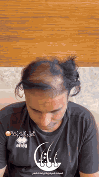 زراعة شعر • الحارثية بغداد • كثافة عالية