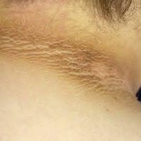 فحص الانسولين • مقاومة الانسولين HOMA-IR • ناحية الزاب