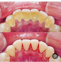 الي محتاج تنظيف وتبيض وازاله تكلسات اسنانه يتواصل ويانه على هذه الرقم ...