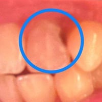 حشوات جذور • أسنان أمامية • حلة شارع 40