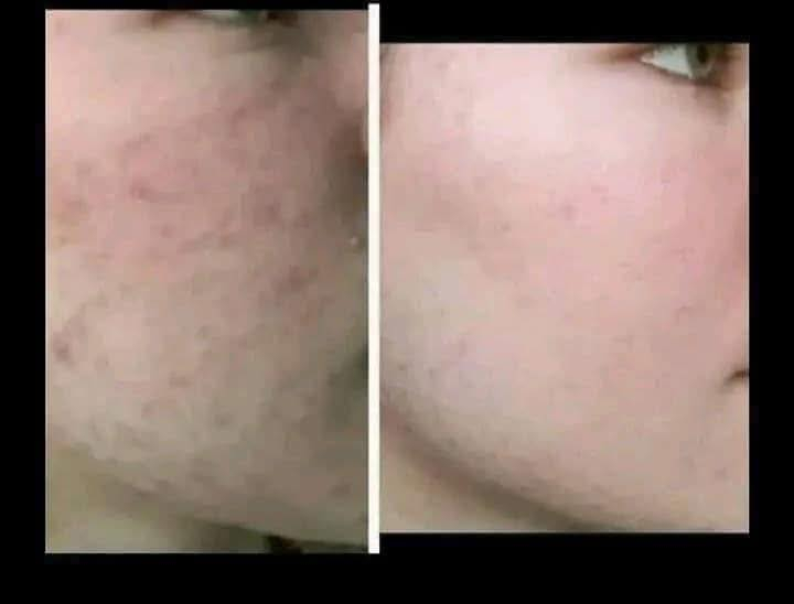 تۆش بەدەست کێشەکانی پێستەوە دەناڵێنی نازانی چی لێبکەیت و بەچی چارەسەری بکەیت🤔
کرێمێکت دەوێت بەگرەنتی👌 پارەگەڕانەوە ئەگەر سوودی نەبوو لەماوەی تەنها 🔺١٥ڕۆژدا
🟡سێتی کرێمی ئەمەریکی ئەڵلماس کەخاوەنی کوالێتی کۆنترۆڵە ☑️
ئەوەی ئەم کرێمەی بەکارهێناوە بۆهەمیشەیی ماڵئاوای لەتەواوی کێشەکانی ڕوخساری کردوە و دەوروبەری داوای ئەم کرێمەیان لێکردوە بەهۆی سوودو گۆڕانکاریە زۆرەکەیەوە 👍
ئەم کرێمە چارەسەری تەواوی ئەم کێشانەی ڕوخسارت بۆدەکات بەگرەنتیەوە 
🔺لابردنی زیپکەو شوێنەواری زیپکە
🔺لابردنیی پەڵەی سەرپێست و ژێرپێست
🔺لابردنی ڕەشی ژێرچاوو یەک ڕەنگ کردنی روخسار بەتەواوی
🔺لابردنی سوتاوی بەرخۆرو نەرم کردن و سافکردنی دەماوجاوو بەگشتی یەک ڕەنگردنی 
🟡کارتی گرەنتی و زەمانی بەکارهێنانی لەگەڵدایە سوودی تەواوت وەرنەگرت قەرەبوی تەواو دەکرێیتەوە 
بۆداواکردن و زانیاری زیاتر پەیوەندی بەم ژمارەیەوەبکەن
🚕گەیاندنمان بەردەستە 
📞***********
