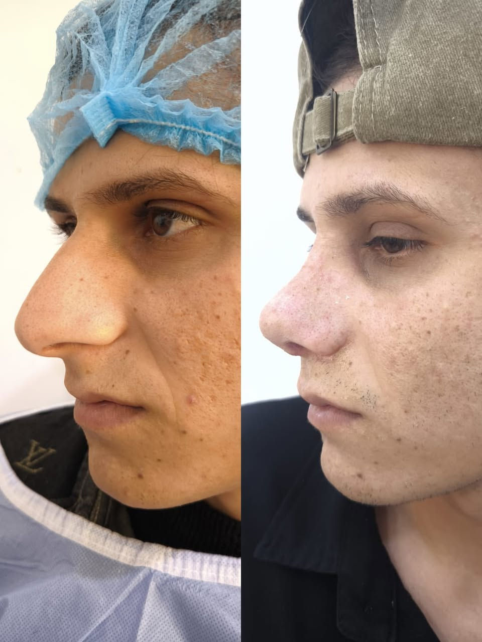 خشمك مو عاجبك؟ 🤔 ودك بملامح متناسقة تبرز جمالك؟ ✨ مركز الشرق الأوسط للتجميل يقدم لك الحل الأمثل! 🤩 عملية تجميل الأنف تخدير موضعي وبأيدي خبيرة الدكتور محمود أحمد! 💪🏻 بكلفة مناسبة جداً ٦٠٠ الف دينار بس! 🔥 للحجز والاستفسار‏ 078-132-88144‏
 اتصل بنا الآن! 📞 #تجميل_الانف #مركز_الشرق_الاوسط #الدكتور_محمود_احمد #تجميل #تنسيق_ملامح #جمال #عروض #تخفيضات #حجز_موعد #استشارة_طبية #بغداد #العراق #الجمال_العراقي"
