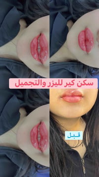 رسمات الفيلر ماعم تخلص بعيادتنا 👄💄 لكل صبية ملامح جذابة خاصة فيها ولكل...