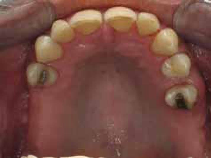 السلام عليكم اللي فاقد جزء من أسنانه مثل اللي بالصور ويحتاج تعويض بطقم أسنان جزئي متحرك يگدر يراسلني واتساب *********** احددله موعد في عيادات جامعة الهادي بس اهم شي الالتزام لان العلاج يتضمن اربع جلسات
