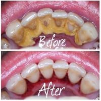 تنظيف أسنان • تكلسات • كلية الرشيد