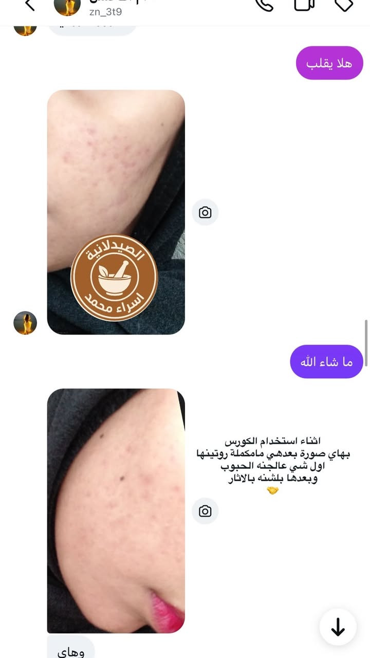 شوفوا شلون علاج بشرتها بأقل من  شهر رغم جان يحتاج الها روتين مدته شهرين بس شافت نتيجة ترضيها خلال شهر بس ❤️


**إذا كنت صاحب هذا الإعلان وتريد حذفه لأي سبب، رجاءا أرسل رسالة إلى الدعم الفني**