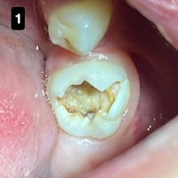 حشوة جذر • ترميم سن • حي 17