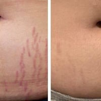 علاج تشققات الجلد • من الولادة والسمنة • توصيل جميع المحافظات