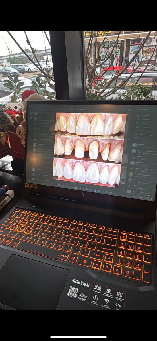 Acer nitrov16 AI
• المعالج: Intel Core i7-14650HX (جيل 14)
 • كرت الشاشة: NVIDIA RTX 4050 (6GB)
 • الرام: 16GB DDR5
 • التخزين: 512GB SSD NVMe
 • الشاشة: 16 إنچ IPS
 • دقة: 1920×1200
• 144Hz – 165Hz
 • الوزن: حوالي 2.5 كغم
 • كيبورد: مضيء
• Wi-Fi 6 + HDMI + USB
السعر1,250,000
+9647728920825
