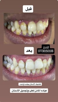 تنظيف اسنان • عيادة الماس • البونافع