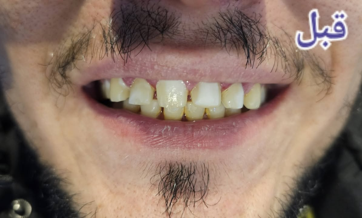 هدوء، واهتمام، وعناية تبدأ من المكان 🤍

Where precision comes first 🦷
Where space is designed to feel open and calm 🤍
Where comfort begins before you sit down ✨
⚘️مراجع يعاني من اصفرار وفراغات بين الاسنان ..تم تنظيف الاسنان وصقلها وعمل تركيبات مؤقتة ..وعمل تركيبات الايماكس الثابتة  ذات القوة والجمالية ليكسب بذلك ابتسامة مشرقة⚘️
📞للحجز واتس  ***********
يوجد خصم ٣٥%للعوائل ذات الدخل المحدود 

 📍 كربلاء _حي الفارس _الشارع الرئيسي قرب محطة وقود الفارس/مقابل اسواق جدو
