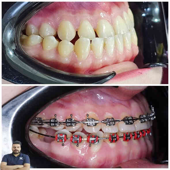 عذراء كانت تعاني من تقدم بالفك السفلي كدرنة نعدل اسنانهة ونرجع ابتسامتهة خلال مدة سنة ونص من العلاج

العنوان / المسيب / شارع البلدية / مقابل دكتور جعفر وفي للاطفال 

للحجز والاستفسار 
***********
***********
