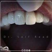 ✨ تريد ابتسامة هوليود ثابتة وبخصم 30%؟  هسه فرصتك حتى تحصل على ابتسامة...