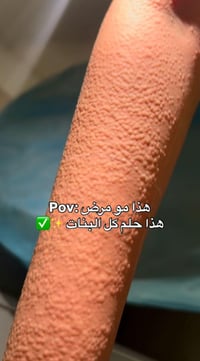 ليزر فول بدي عدا الضهر والبطن جهاز كاندلا الثلجي المتطور بسعر 60 الف ف...