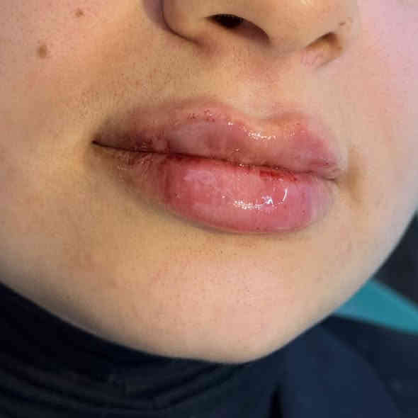 أذابه فلر محقون بطريقه غلط  متكتل وصاعد ع منطقه الشارب وتجديد الحقن❤️‍🔥😍 +اسحبو جان تشوفون باقي الجمال 🔥 المسيب *********** 

#فلر_شفايف #فلرشفة_فلر_وجنات_فلرخطوط_ضاحكة_فلرذقن_تكساس_تكنيك❤️❤️❤️ #الشعب_الصيني_ماله_حل😂😂
