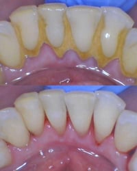 تنظيف أسنان احترافي • نزف اللثة • كلية طب الاسنان