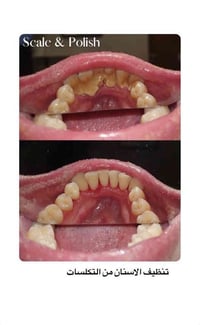 تنظيف اسنان • تكلسات تصبغات • علاج مجاني