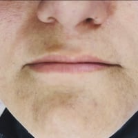 احلى فيلر • فيلر • تجميل